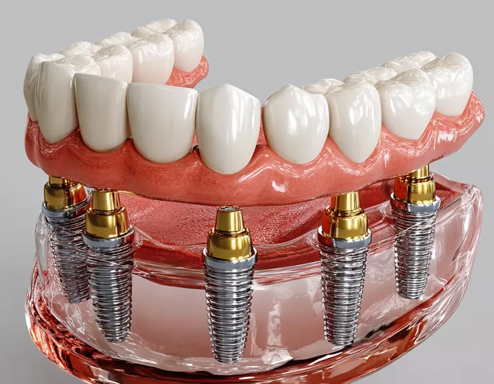 имплантация все на 4